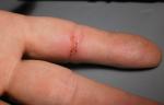 finger_cut